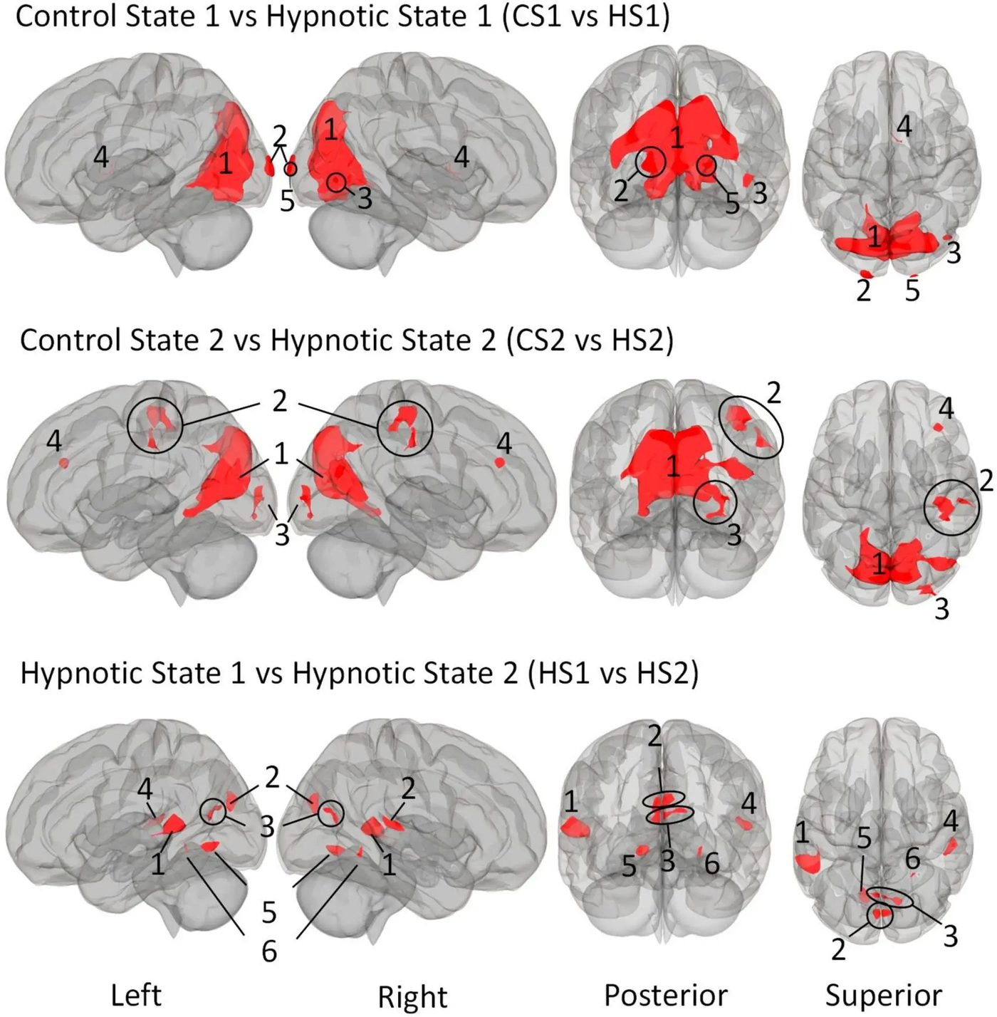 Views of the brain from the left, right, back and top with marked regions: control state versus hypnosis state 1, control state versus hypnosis state 2, and the two hypnosis states against each other